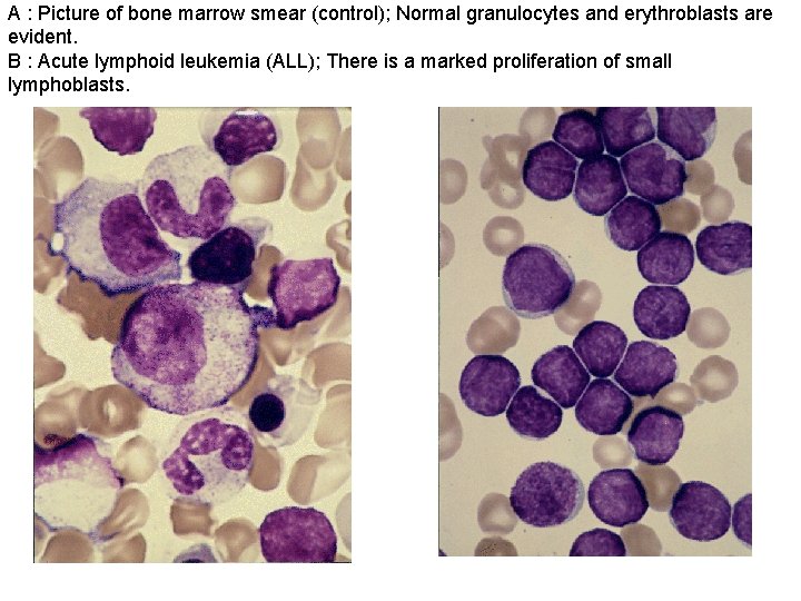 A : Picture of bone marrow smear (control); Normal granulocytes and erythroblasts are evident.