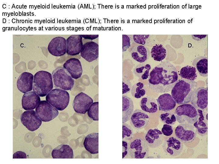 C : Acute myeloid leukemia (AML); There is a marked proliferation of large myeloblasts.