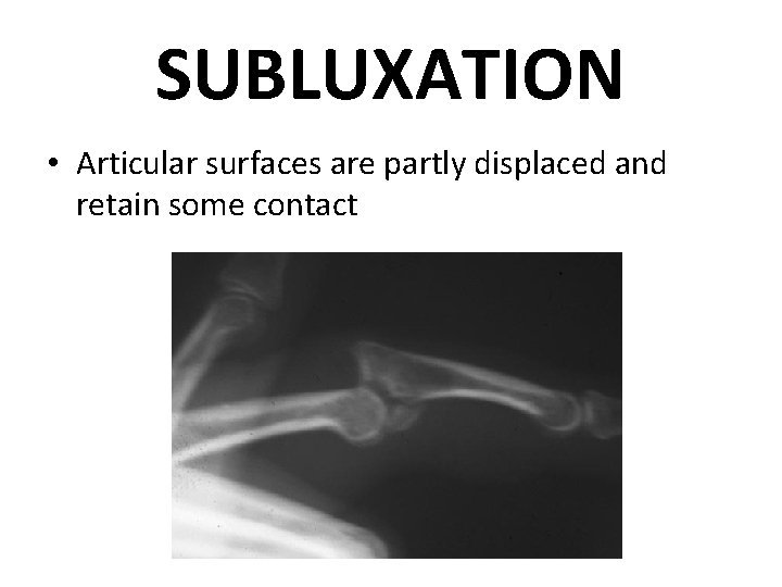 SUBLUXATION • Articular surfaces are partly displaced and retain some contact 