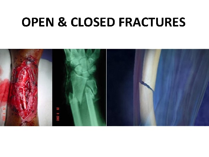 OPEN & CLOSED FRACTURES 