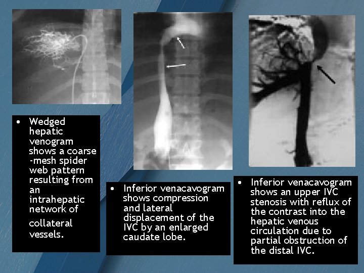  • Wedged hepatic venogram shows a coarse -mesh spider web pattern resulting from
