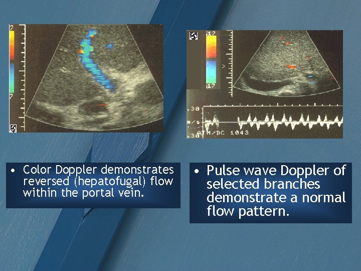  • Color Doppler demonstrates reversed (hepatofugal) flow within the portal vein. • Pulse