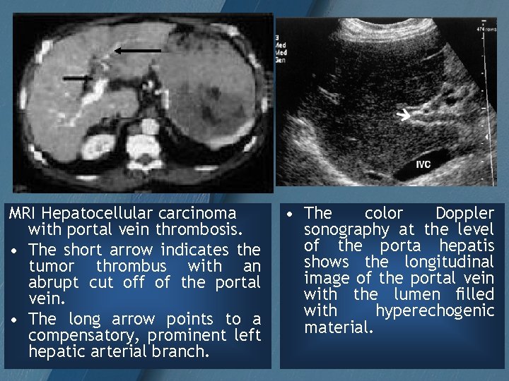 MRI Hepatocellular carcinoma with portal vein thrombosis. • The short arrow indicates the tumor