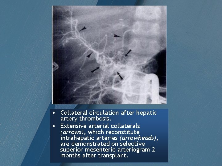  • Collateral circulation after hepatic artery thrombosis. • Extensive arterial collaterals (arrows), which