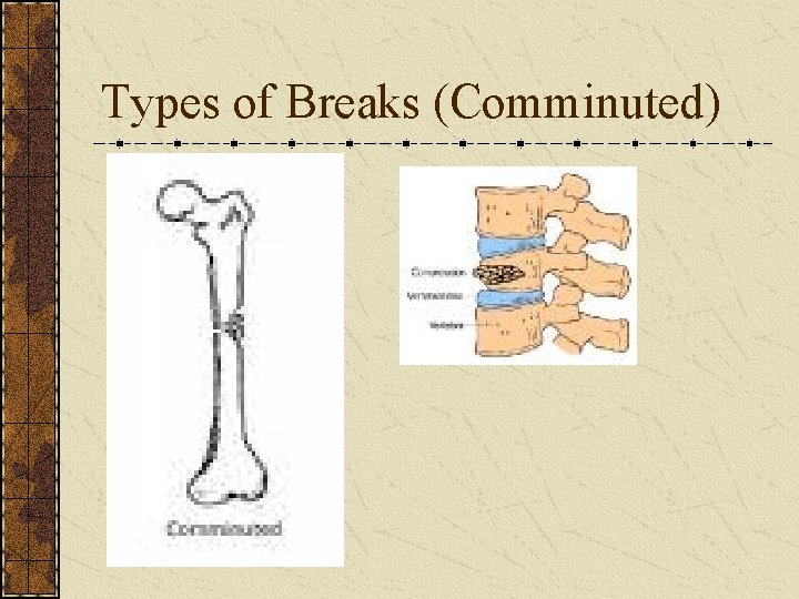Types of Breaks (Comminuted) 