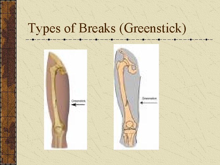 Types of Breaks (Greenstick) 
