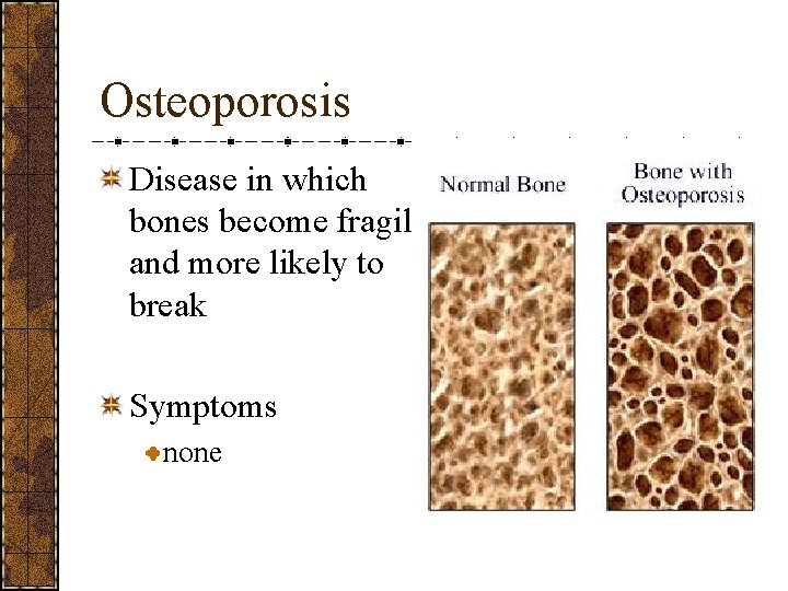 Osteoporosis Disease in which bones become fragile and more likely to break Symptoms none