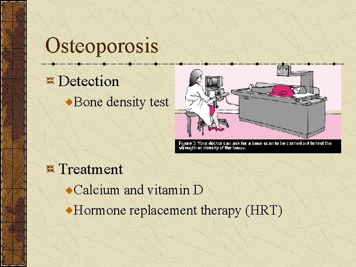 Osteoporosis Detection Bone density test Treatment Calcium and vitamin D Hormone replacement therapy (HRT)