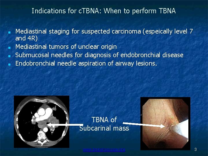 Indications for c. TBNA: When to perform TBNA ■ ■ Mediastinal staging for suspected