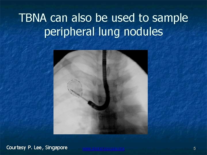 TBNA can also be used to sample peripheral lung nodules Courtesy P. Lee, Singapore