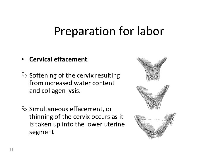 Preparation for labor • Cervical effacement Ä Softening of the cervix resulting from increased