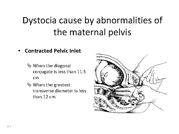 Dystocia cause by abnormalities of the maternal pelvis • Contracted Pelvic Inlet Ä When