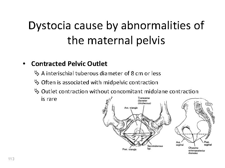 Dystocia cause by abnormalities of the maternal pelvis • Contracted Pelvic Outlet Ä A