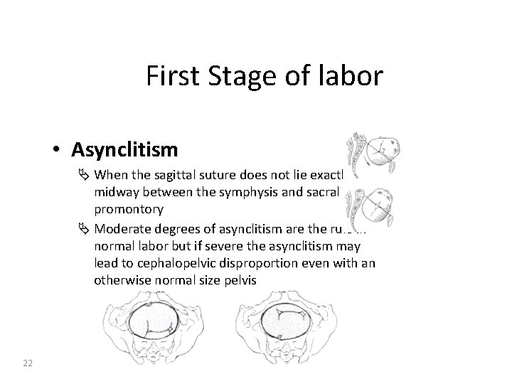 First Stage of labor • Asynclitism Ä When the sagittal suture does not lie