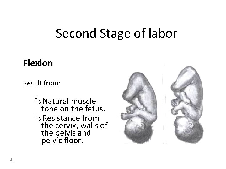 Second Stage of labor Flexion Result from: ÄNatural muscle tone on the fetus. ÄResistance