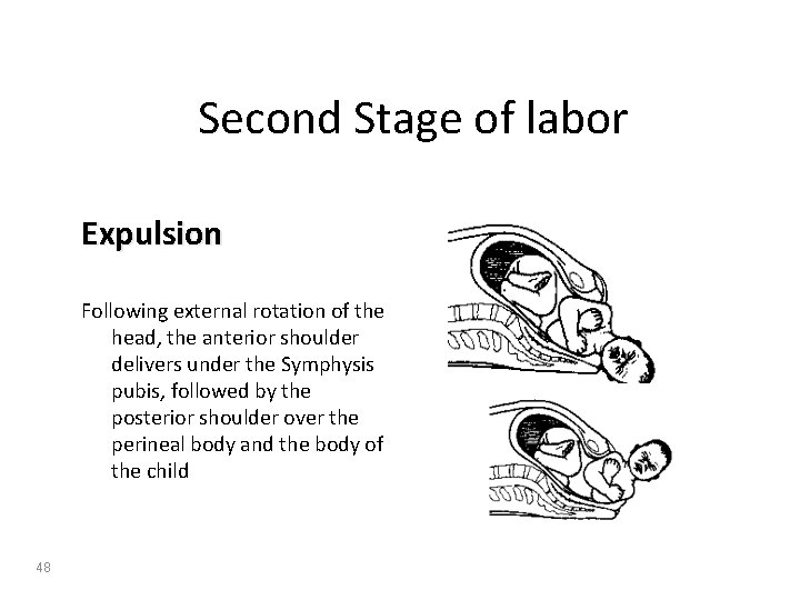 Second Stage of labor Expulsion Following external rotation of the head, the anterior shoulder