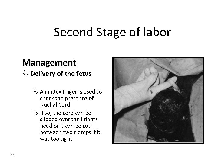 Second Stage of labor Management Ä Delivery of the fetus Ä An index finger