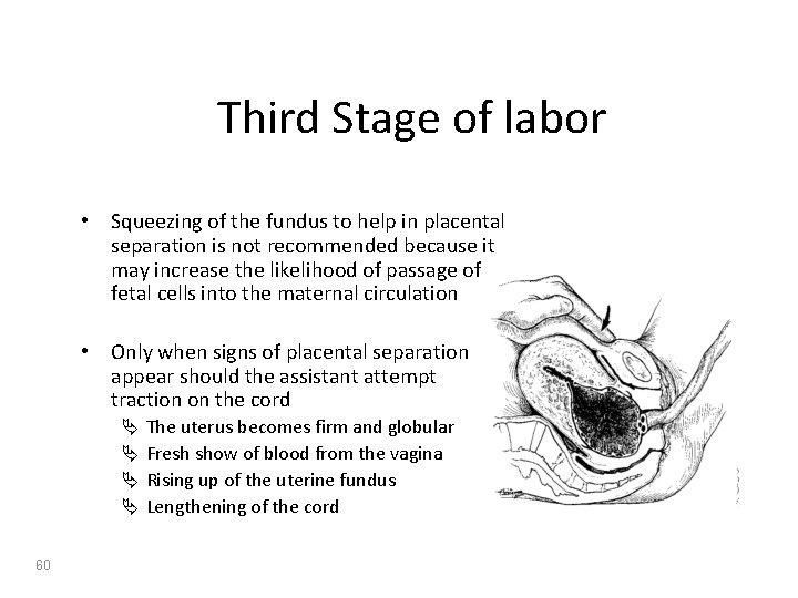 Third Stage of labor • Squeezing of the fundus to help in placental separation