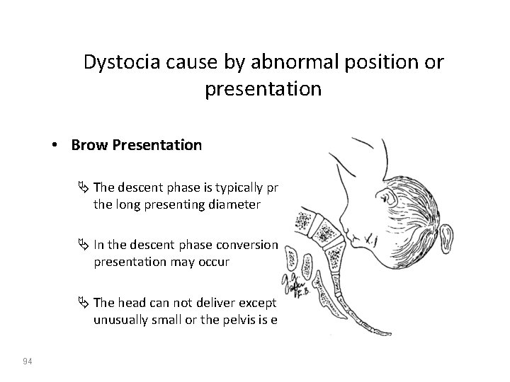 Dystocia cause by abnormal position or presentation • Brow Presentation Ä The descent phase