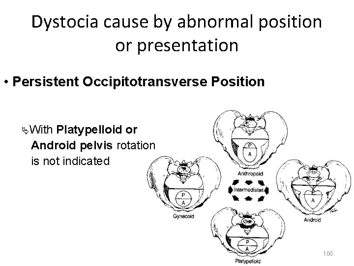 Dystocia cause by abnormal position or presentation • Persistent Occipitotransverse Position ÄWith Platypelloid or
