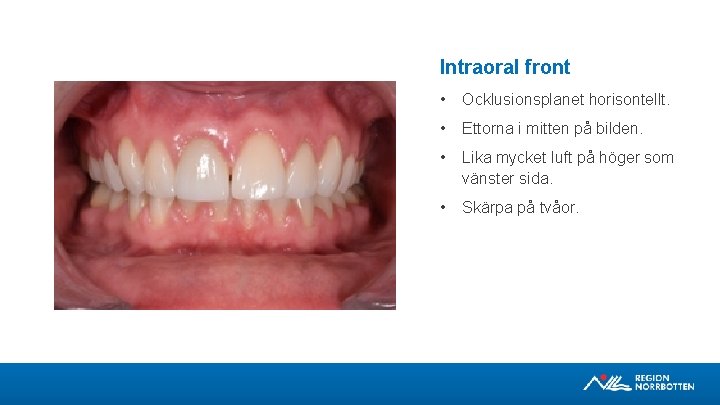 Intraoral front • Ocklusionsplanet horisontellt. • Ettorna i mitten på bilden. • Lika mycket