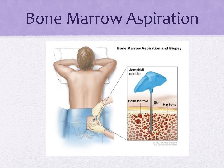 Bone Marrow Aspiration 