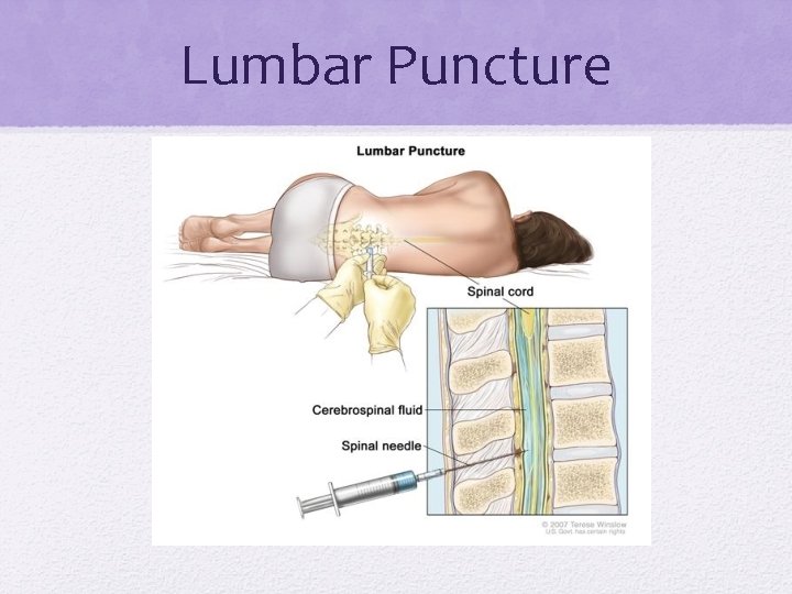 Lumbar Puncture 