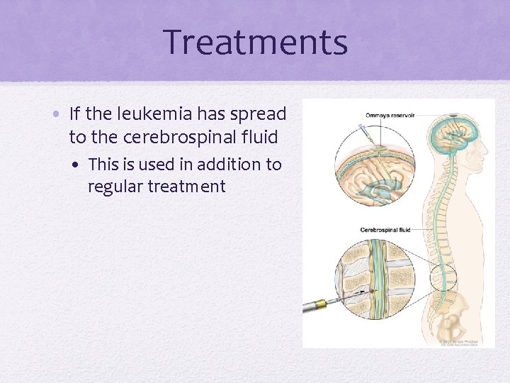 Treatments • If the leukemia has spread to the cerebrospinal fluid • This is