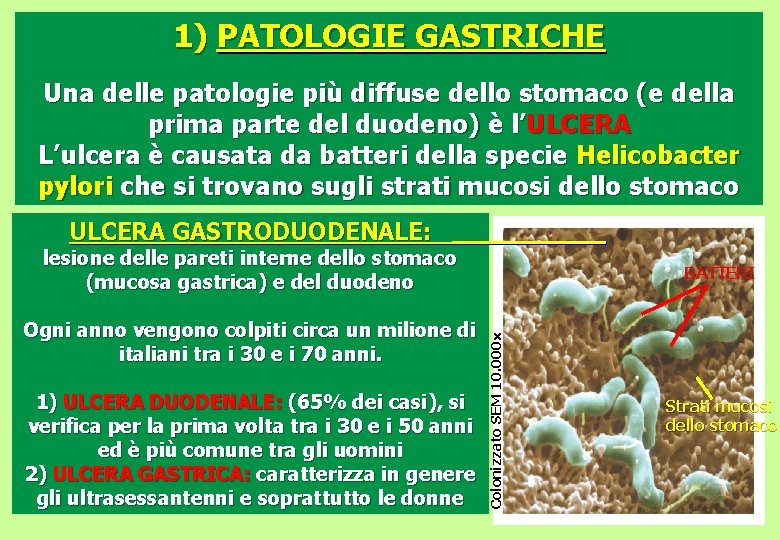 1) PATOLOGIE GASTRICHE Una delle patologie più diffuse dello stomaco (e della prima parte
