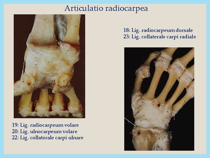 Articulatio radiocarpea 18: Lig. radiocarpeum dorsale 23: Lig. collaterale carpi radiale 19: Lig. radiocarpeum