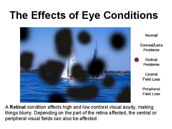 The Effects of Eye Conditions A Retinal condition affects high and low contrast visual