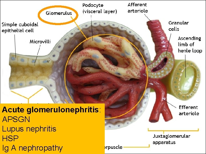Acute glomerulonephritis: APSGN Lupus nephritis HSP Ig A nephropathy 