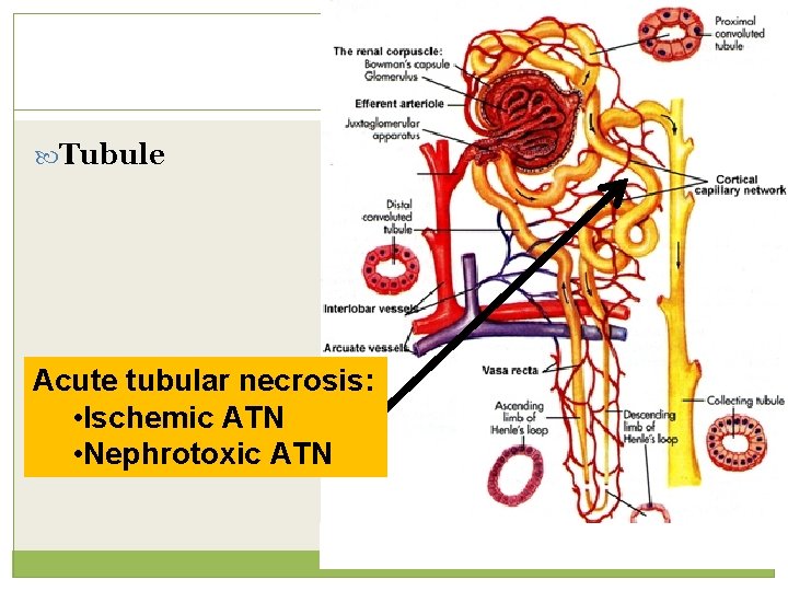  Tubule Acute tubular necrosis: • Ischemic ATN • Nephrotoxic ATN 