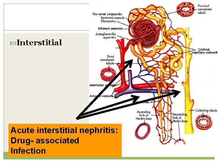  Interstitial Acute interstitial nephritis: Drug- associated Infection 