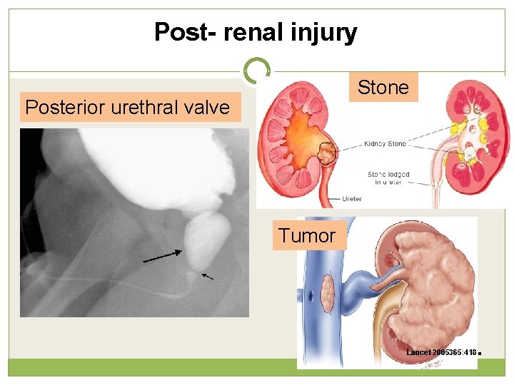 Post- renal injury Stone Posterior urethral valve Tumor Lancet 2005365: 418 . 