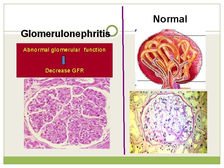 Glomerulonephritis Abnormal glomerular function Decrease GFR Normal 