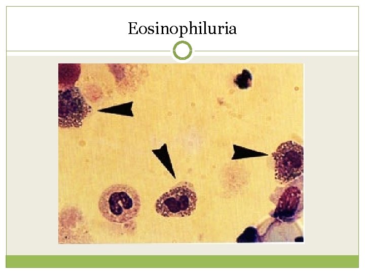 Eosinophiluria 