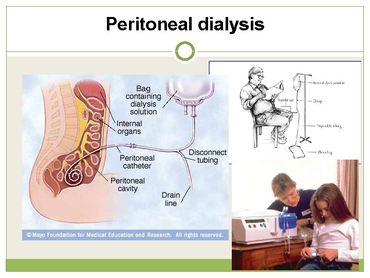 Peritoneal dialysis 