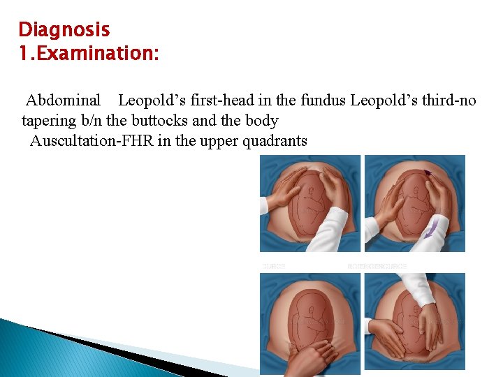 Diagnosis 1. Examination: Abdominal Leopold’s first-head in the fundus Leopold’s third-no tapering b/n the