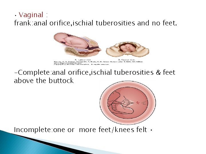 Vaginal : frank: anal orifice, ischial tuberosities and no feet. • -Complete: anal orifice,