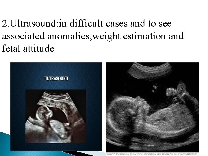 2. Ultrasound: in difficult cases and to see associated anomalies, weight estimation and fetal