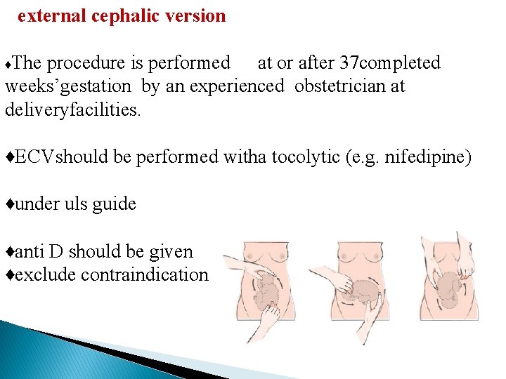 external cephalic version ♦The procedure is performed at or after 37 completed weeks’gestation by