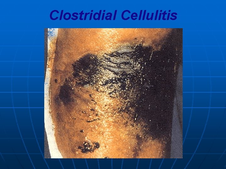 Clostridial Cellulitis 
