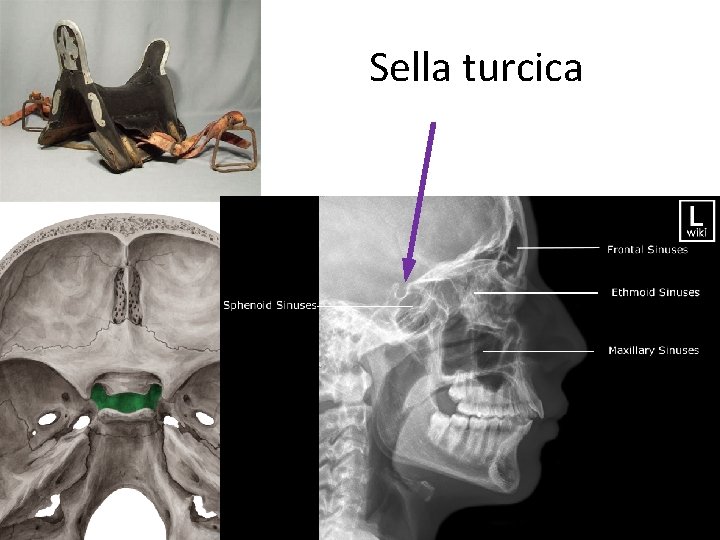 Sella turcica 