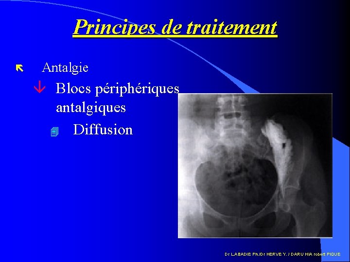 Principes de traitement ë Antalgie â Blocs périphériques antalgiques 4 Diffusion Dr L. ABADIE