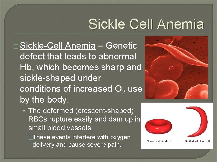 Sickle Cell Anemia � Sickle-Cell Anemia – Genetic defect that leads to abnormal Hb,