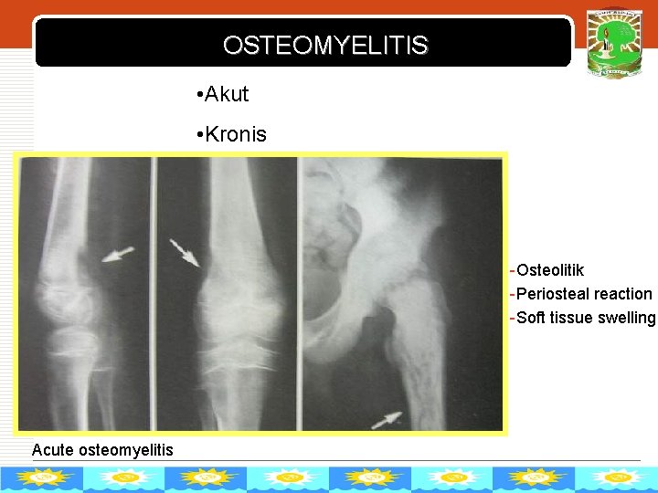 OSTEOMYELITIS LOGO • Akut • Kronis -Osteolitik -Periosteal reaction -Soft tissue swelling Acute osteomyelitis