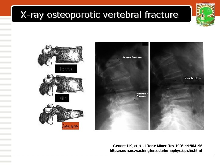 X-ray osteoporotic vertebral fracture LOGO Normal Mild Severe Genant HK, et al. J Bone