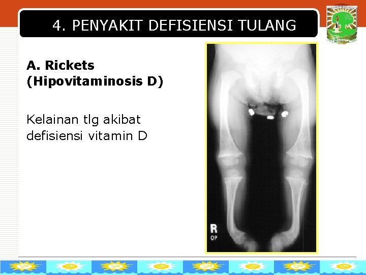 4. PENYAKIT DEFISIENSI TULANG A. Rickets (Hipovitaminosis D) Kelainan tlg akibat defisiensi vitamin D