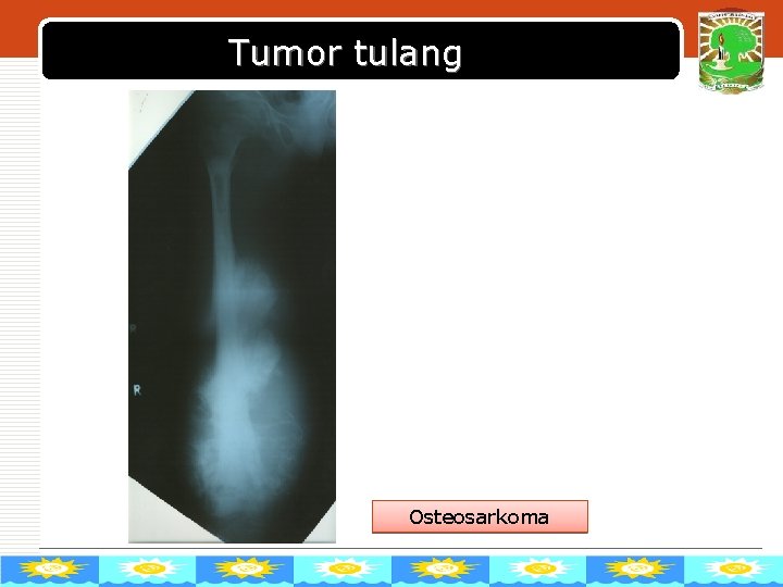 Tumor tulang Osteosarkoma LOGO 